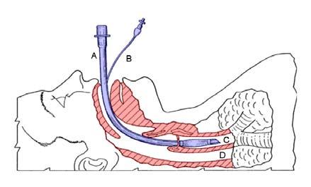 Rescue Breathing with an Advanced Airway This represents a simplification of the 2010 Guidelines recommendations, to provide a single number that rescuers will need to remember for ventilation rate,