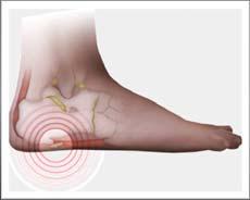 Sources of Heel and Foot Pain Heel pain is the most common foot problem and affects 2 million