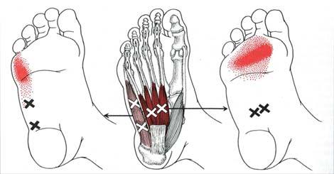 Treatment of Heel and Foot Pain Trigger