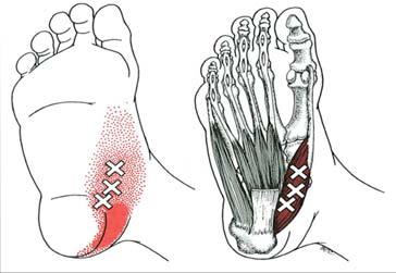 Treatment of Heel and Foot Pain