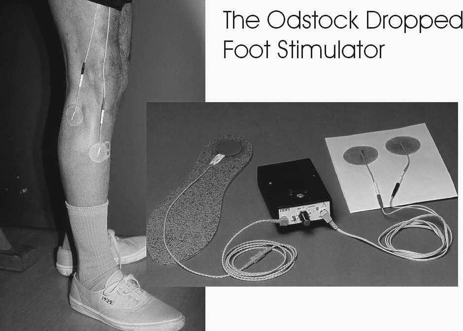 The use of electrical stimulation for correction of dropped foot in subjects with upper motor neurone lesions.