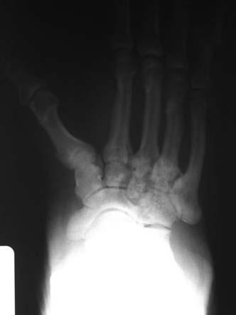 arrows indicate the cuboid-metatarsal joint.