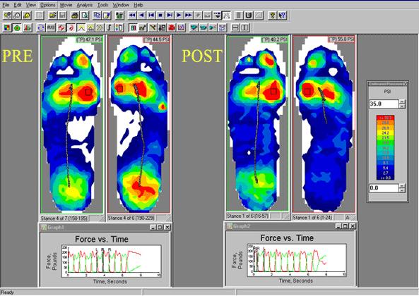 This data is saved and used to analyze the patient and compare the individual legs of the patient. This helps compare the patient s real leg with their prosthetic leg.