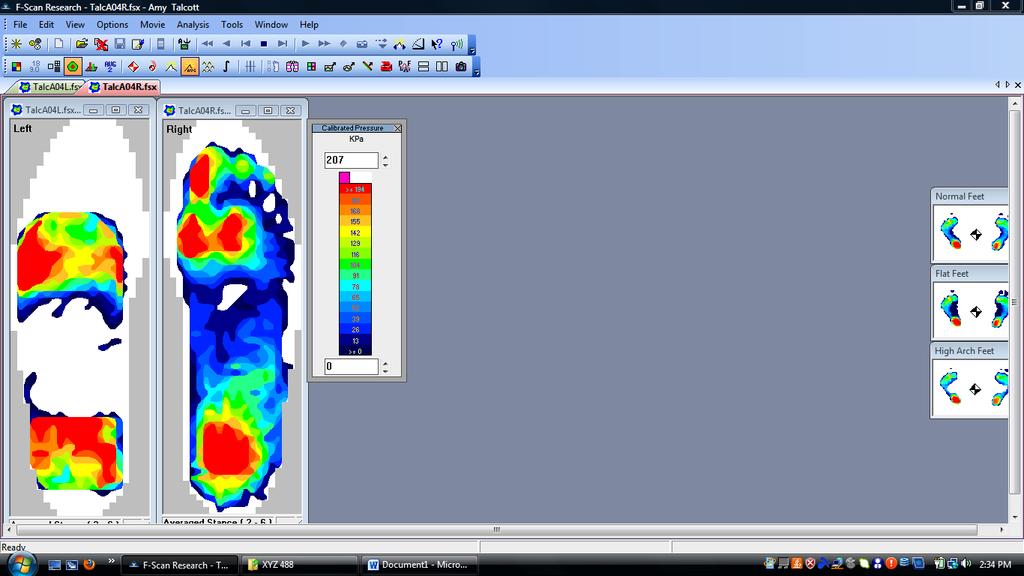 One of the features in the F-Scan software that was also used to analyze the patient s gait was center of force (COF) trajectory.