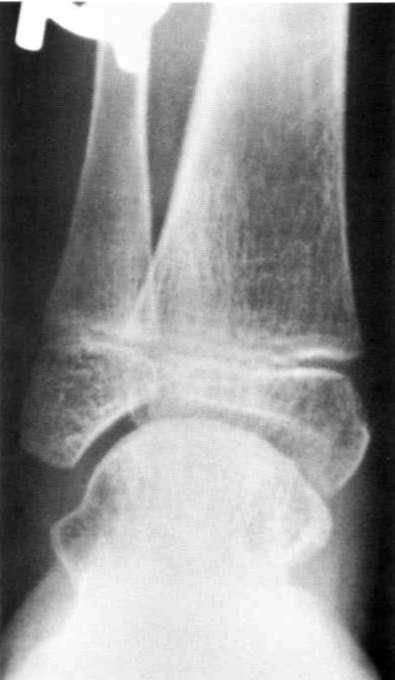 64 who had had subtalar arthrodesis; more than half complained of discomfort on the lateral side of their ankle joints.