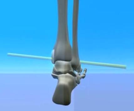 the ankle joint