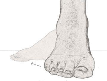 The corresponding contact surfaces of the talus and the calcaneus are incongruent so that they don t fit together at