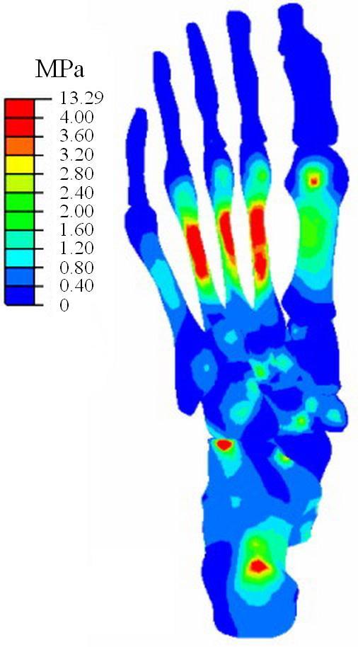 238 Luximon Yan, et al. port condition. The peak pressure in forefoot, midfoot and heel region were 0.10 MPa, 0.06 MPa, 0.14 MPa for H1, 0.09 MPa, 0.09 MPa, 0.16 MPa for H2 and 0.20 MPa, 0.11 MPa, 0.