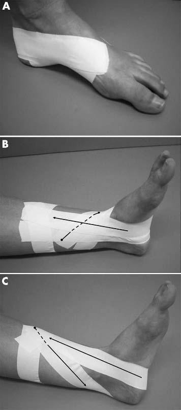 940 Vicenzino, Franettovich, McPoil, et al greater than 10 mm when the foot was moved from relaxed calcaneal standing to subtalar neutral was required for inclusion in the study.