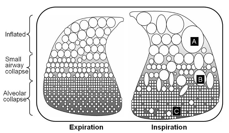 Available online http://ccforum.com/content/9/1/60 Figure 1 Figure 2 Schematic representation of mechanisms of injury during tidal ventilation.