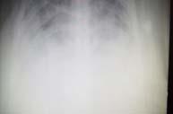ventilators can: Enhance Lung Protective Ventilation Determine the true