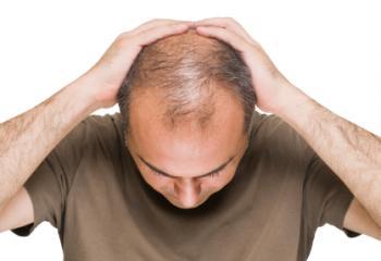 Dihydrotestosterone (DHT) Male pattern baldness is the most common type of balding among males.
