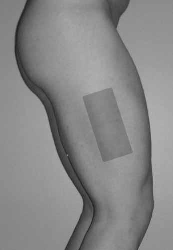 Upper/Outer buttocks is the preferred site for IM injection. The outer side of the leg is also commonly used. 6. Withdraw the syringe. Release the skin with your other hand.