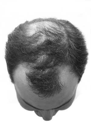 This disorder is characterized by a progressive miniaturization of hair follicles, and a shortening of the anagen phase of hair growth, under androgen influence.