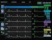 STEMI View A Window to Serial ECG Changes Unstable patients call for extraordinary vigilance. Substantial ST changes can occur between the initial transmission and arrival at the hospital.