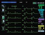 Split-Screen View Quicker, More Confident Decisions At 94% sensitivity for detection of early STEMI, the X Series 12-lead algorithm is unmatched by other popular monitors.