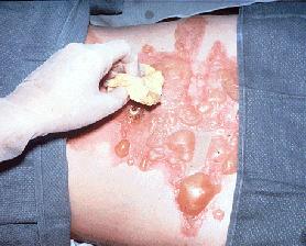 Superficial Partial Thickness Burn (2 nd Degree) Involves the epidermis and part of dermis Mottled red color