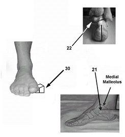 Figure 1. Deep 1 st Web Space. The 1 st metatarsal is shorter than the 2 nd metatarsal creating the deep 1 st web space.