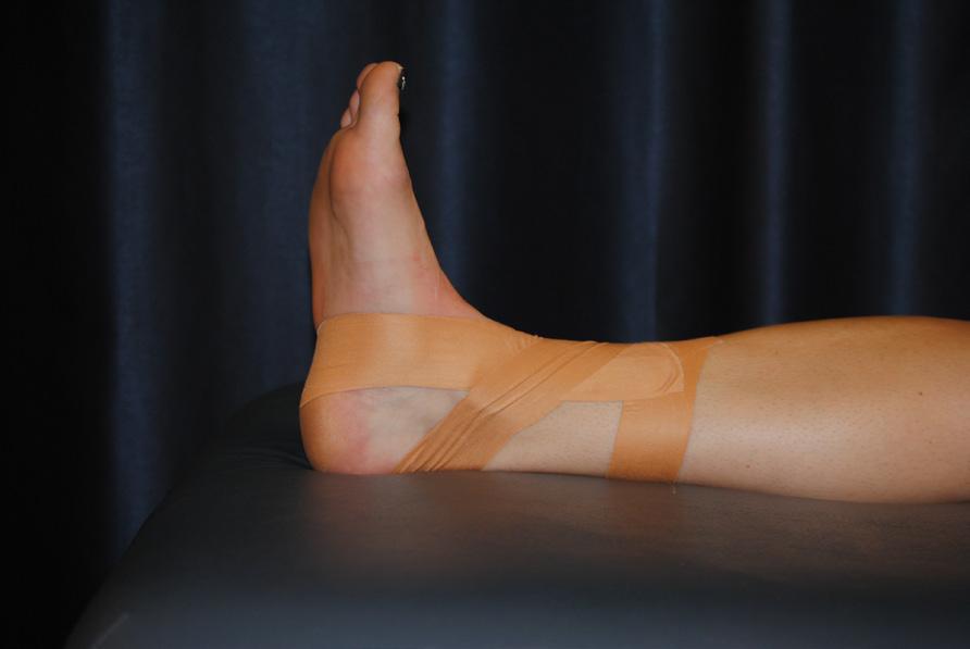 tape that lay across the top of the foot medial to lateral, cross under
