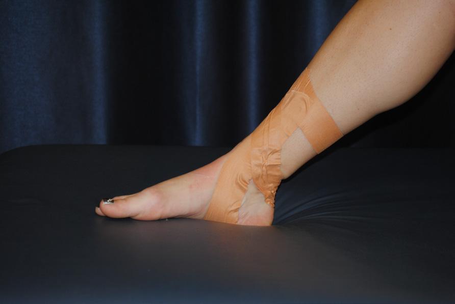 anterior portion of the ankle joint Figure 20- Calcaneal Sling Tape