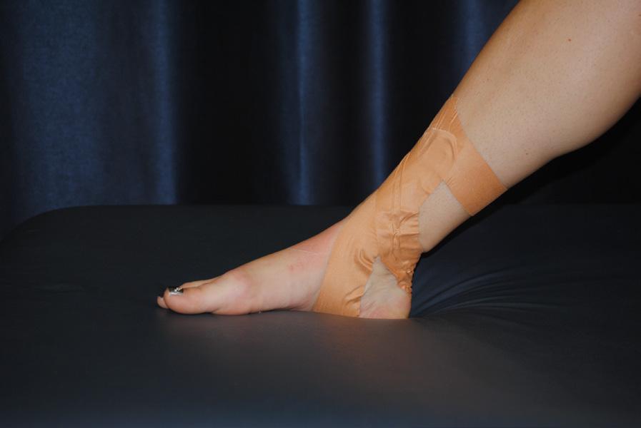 52 Figure 22- Calcaneal Sling Tape Technique (Lateral View).