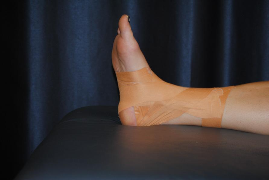 start on the anterior tibia and follow a pattern distally and just anterior