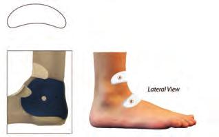 y These pads help to nudge the supinated instep toward the medial side, improving alignment.