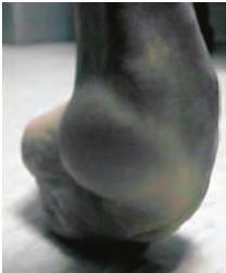 Clubfoot control We have a package of optimizations designed to hold a foot s alignment against clubfoot.