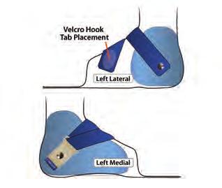 y Allows you to try using the brace without a forefoot strap. Request in Special Instructions section of order form.