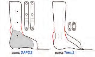 Request in Special Instructions section of order form (e.g., Add toe adduction strap - pull 2nd toe lateral ).