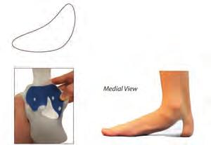 Pronation control (continued) Pronation control pad y Foam support pad that fills ST and medial longitudinal arch areas of the foot inside the brace.