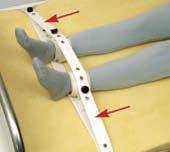 4 inches L 58-88 cm22.8-34.7 inches **Note Velcro : However some jurisdictions might consider Velcro products a restraint, should the patient not be able to remove them independently.
