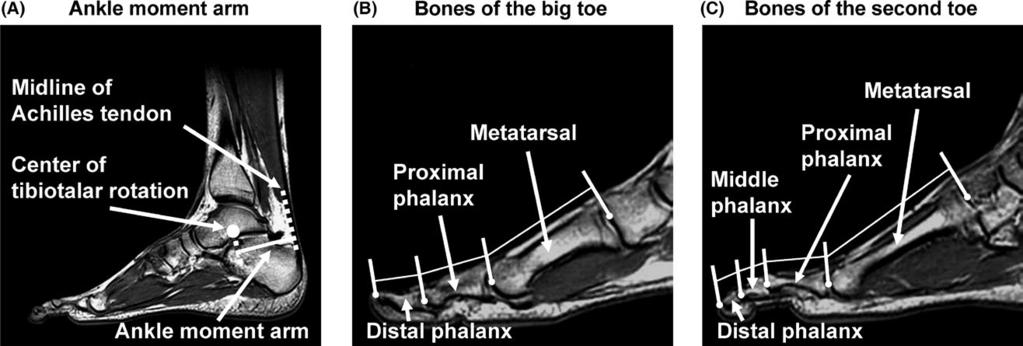 TANAKA et al. 3 FIGURE 1 Representative magnetic resonance imaging scans used for measuring the length of the ankle moment arm (A) and forefoot bones of the big (B) and second (C) toes.
