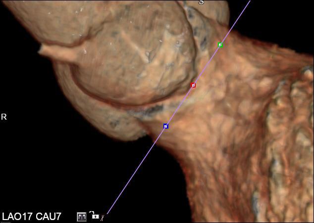 TAVR- C-Arm Angles The valve plane is automatically generated and superimposed on the 3D images to predict the angle of implantation. 3D view must be in the AP position. Click Valve Plane.