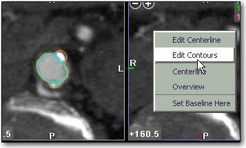 TAVR Edit Contour Right click in CPR view.
