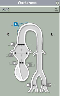 TAVR-Measure/Modify Aortic Neck Angle Click Aortic Neck Angle on the findings list. Angle tool is active by default.