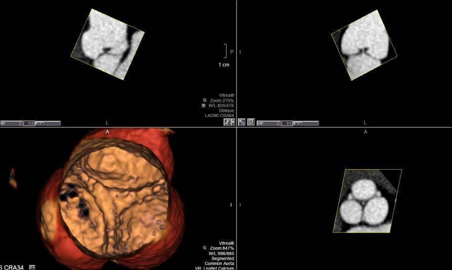 TAVR- Leaflet Calcium View Turn off Show Vessel. Select Preset Leaflet Calcium. Rotate the image superior to inferior.