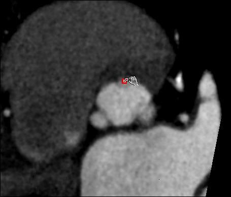 Scroll to identify the left coronary cusp.