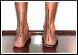 Adequate 1 st ray mobility 39 FOOTWEAR Static measures of foot posture are regularly used