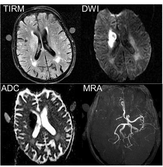 Clinical Application of ADC Model Stroke Diffusion MRI I Slide 7/18 I 07.03.