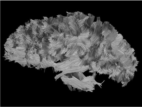 com/news/hi-def-fiber-tracking-helps-pinpoint-brain-damage/ Diffusion MRI I Slide