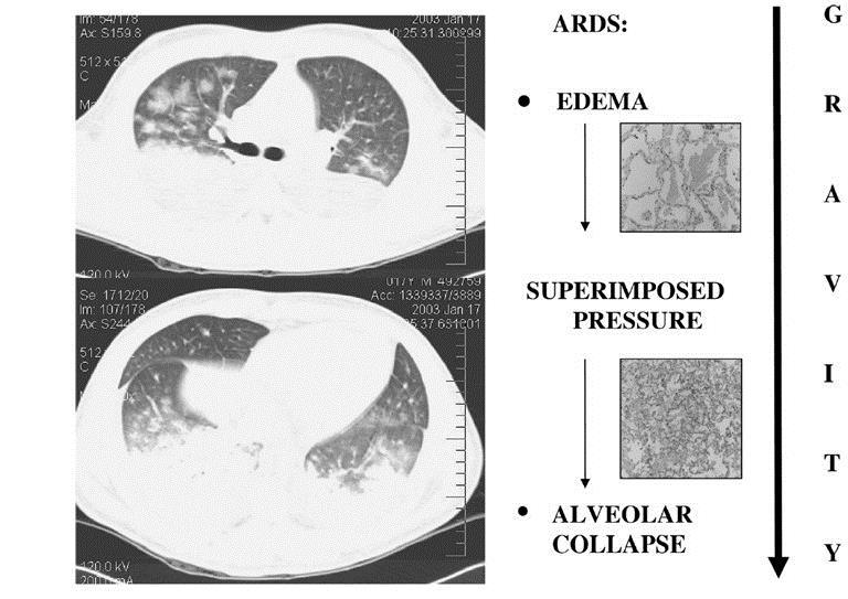 The Acutely Injured Lung (ALI/ARDS) ARDS lungs Normal