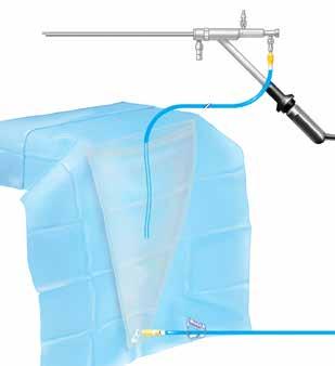 OUTFLOW Y TUBING 1. Connect Y of outflow Y-tubing: a) Attach one end to the underbuttock drape. b) Attach the other short end to the MyoSure outflow channel. 2.