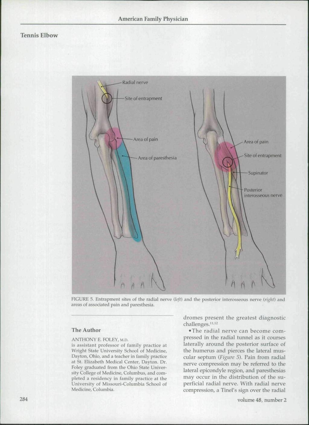 Area of pain Area of pain Area of paresthesia Site of entrapment Posterior interosseous nerve FIGURE 5.