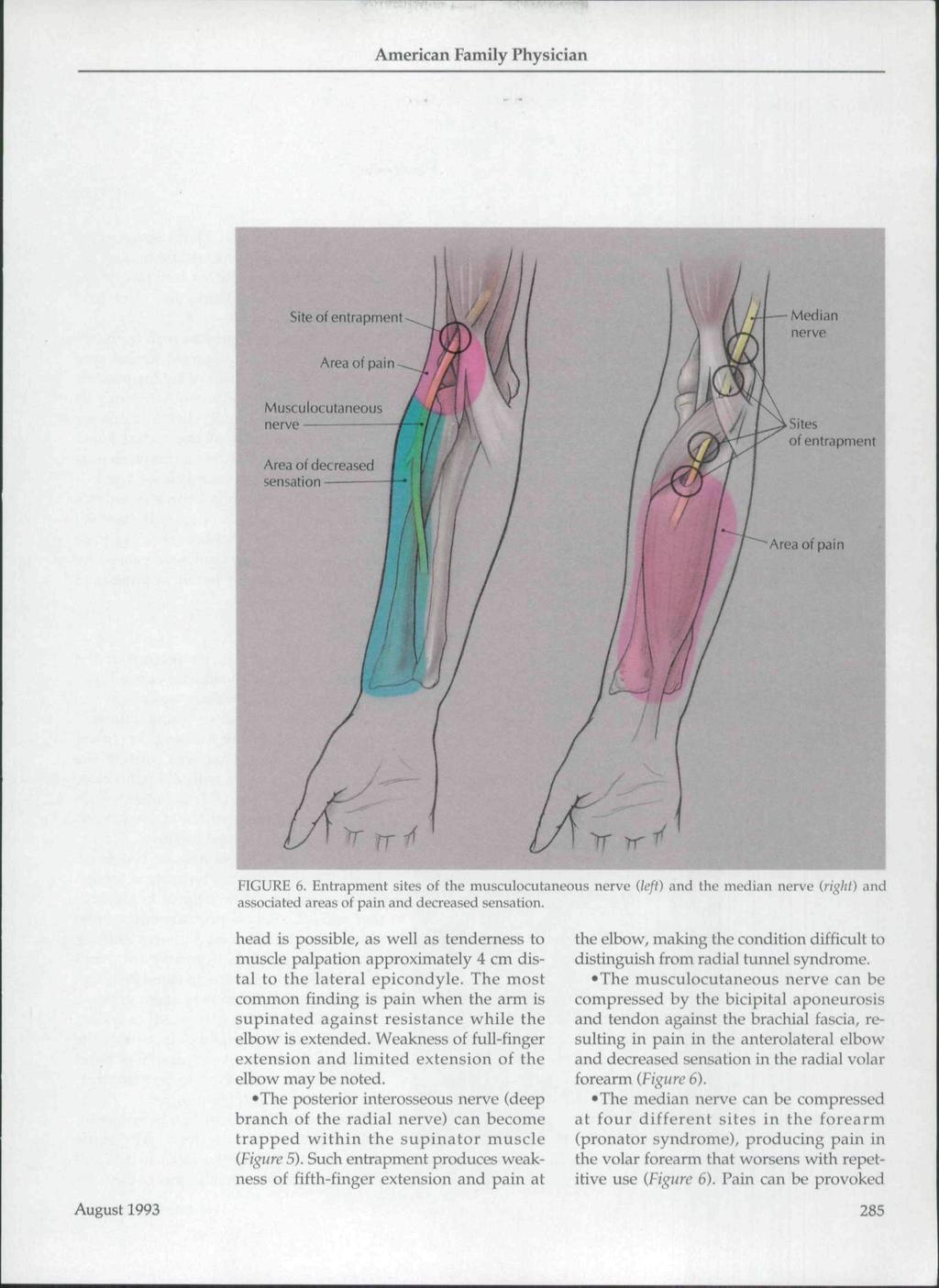 Area of decreased sensation FIGURE 6. Entrapment sites of the musculocutaneous nerve Heft) and the median nerve (right) and associated areas of pain and decreased sensation.