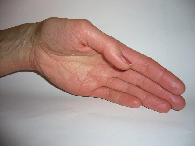 Physical load type V Hand shake position, a too large supination angle combined with an excessive ulnar deviation :