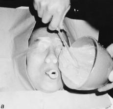 EFFICACY OF A CUSTOM-FABRICATED NASAL MASK 153 be in supine position with their eyes sealed and with their nose plugged, and breathe air or supplemental oxygen through a mouthpiece (fig. 1a).