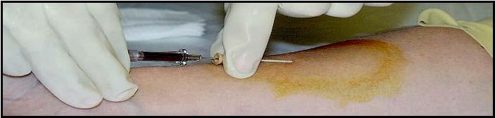 (13) When you have blood in the flash chamber, advance the catheter/needle unit approximately 1/8 inch farther to ensure that the catheter itself is in the vein.