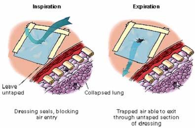 Figure 4-3. Flutter valve effects (inspiration and expiration). d. Dress the Wound. The dressing and bandage will help to protect the airtight material from damage and provide pressure to the wound.