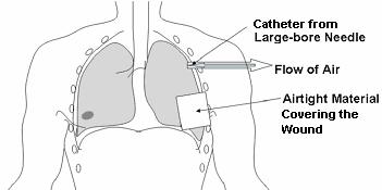 c. Insert the Needle. Firmly insert the needle into the skin above the top of the third rib into the second intercostal space at a 90-degree angle (figure 4-6).